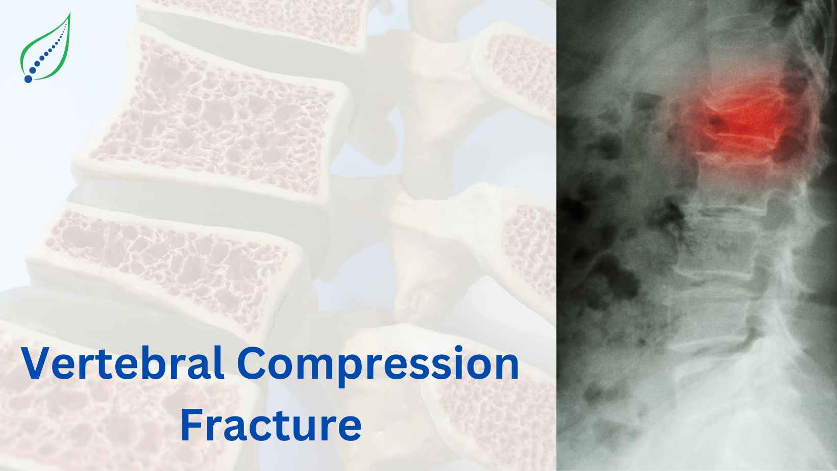 Vertebral Compression Fracture